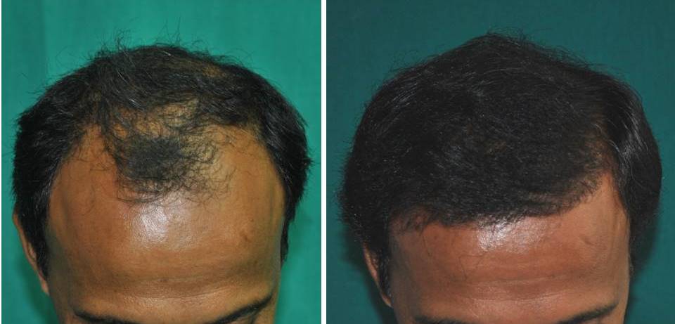 Kerala Hair transplantation result